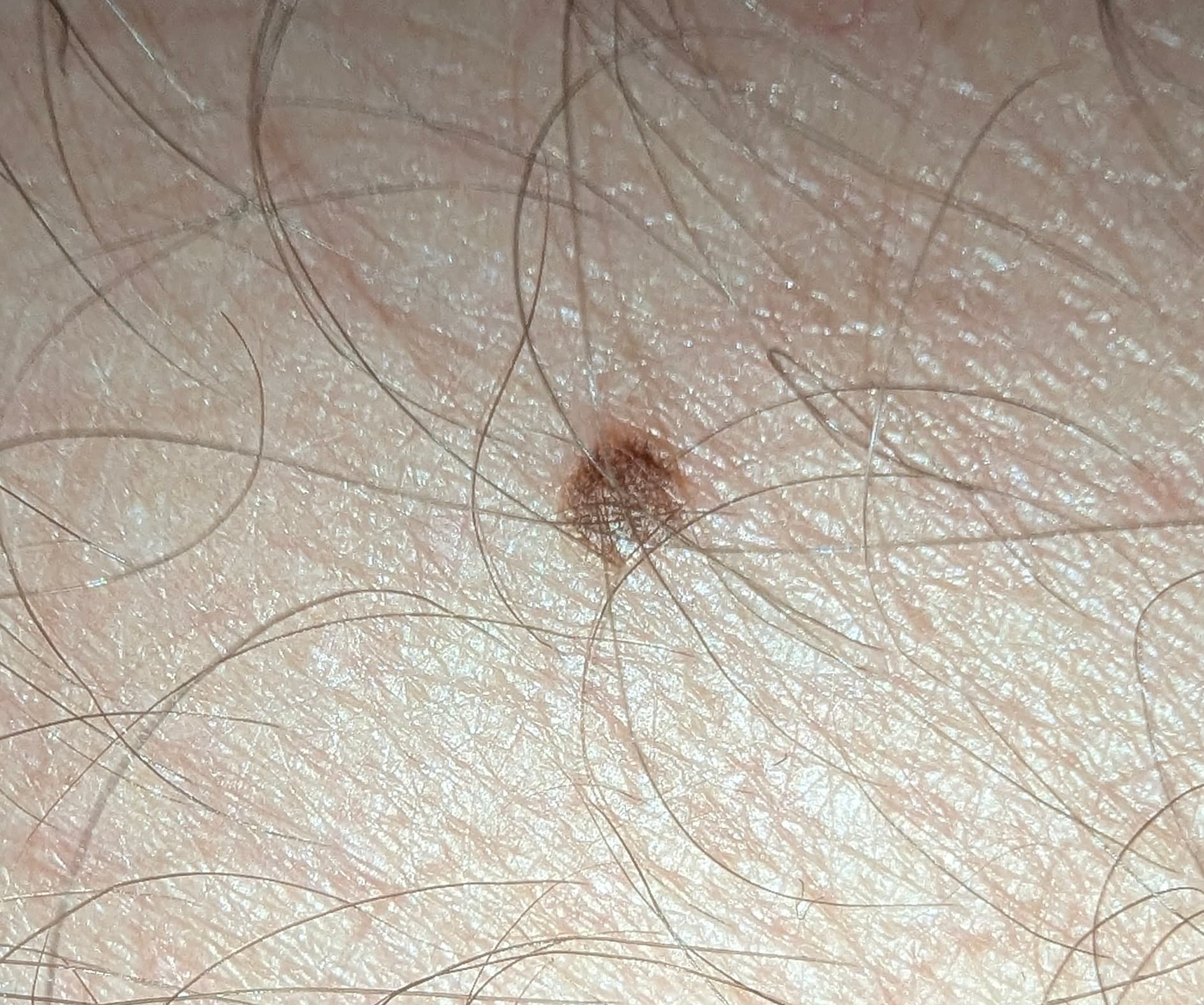 Example of a well-lit skin lesion photo suitable for screening