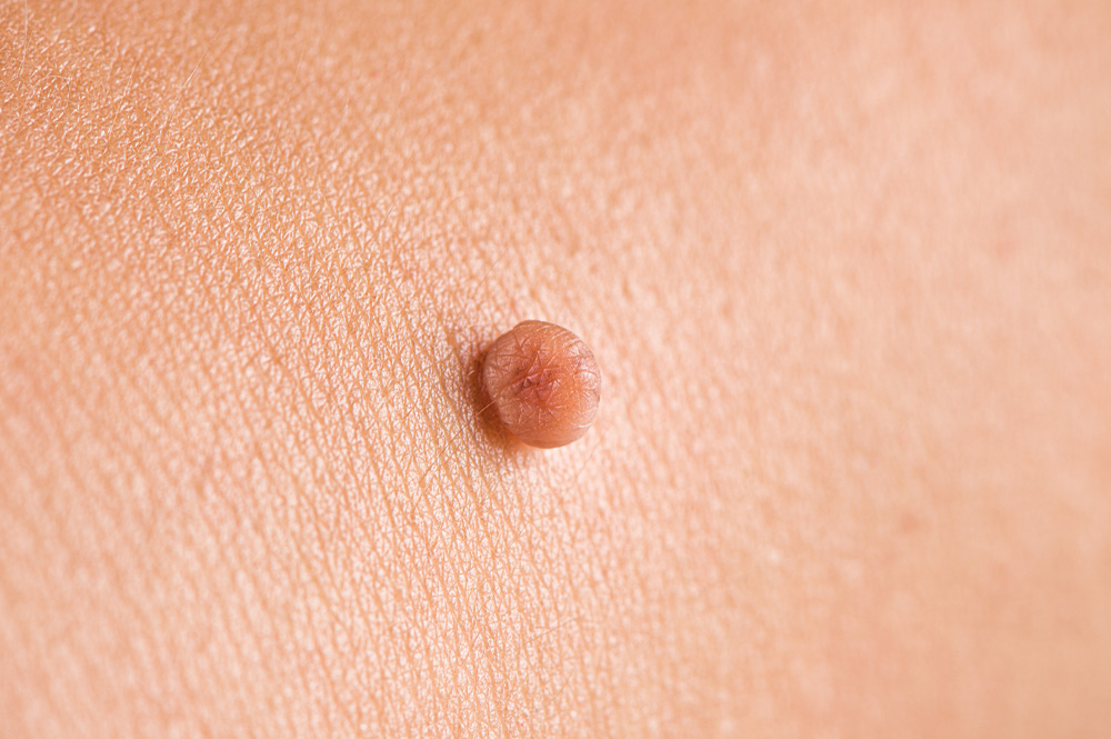 Skin tag example from the original education library